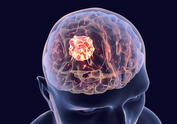 Brain Cancer Specialsit in India