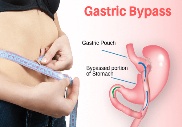 Gastric By pass Surgery treatment