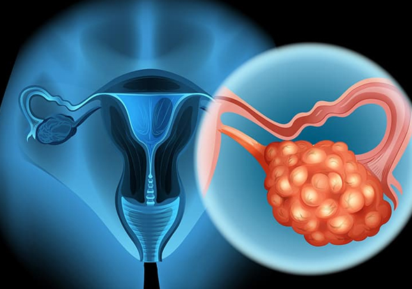 Best Ovarian Cancer Specialist in India