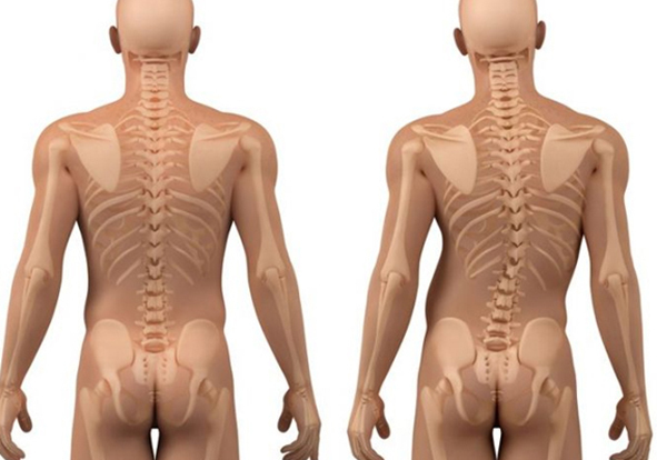 scoliosis specialist in india