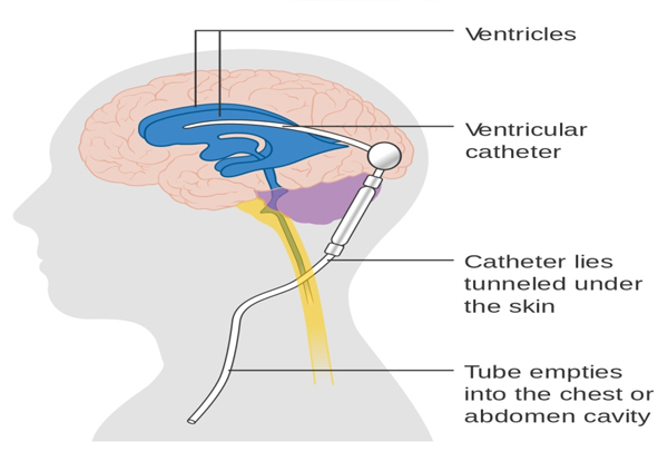 Best Neurologist in india