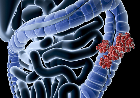 Colon Cancer Specialiat in India