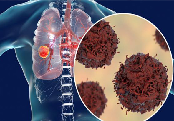 lung cancer specialist in India